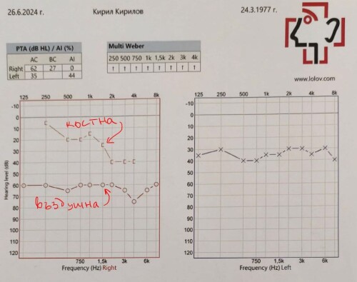 240626 audiograma predi operacia KKirilov