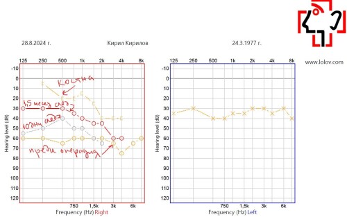 240828 audiograma sled operacia 10dni 1 5mesec KKirilov